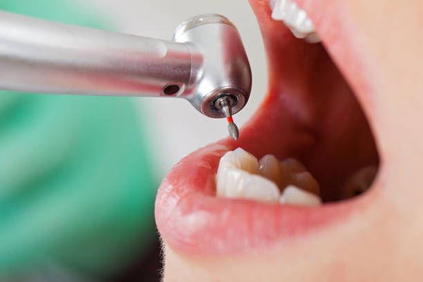 Best Chipped Tooth Repair Near Me  in Encantada Ranchito El Calaboz, TX